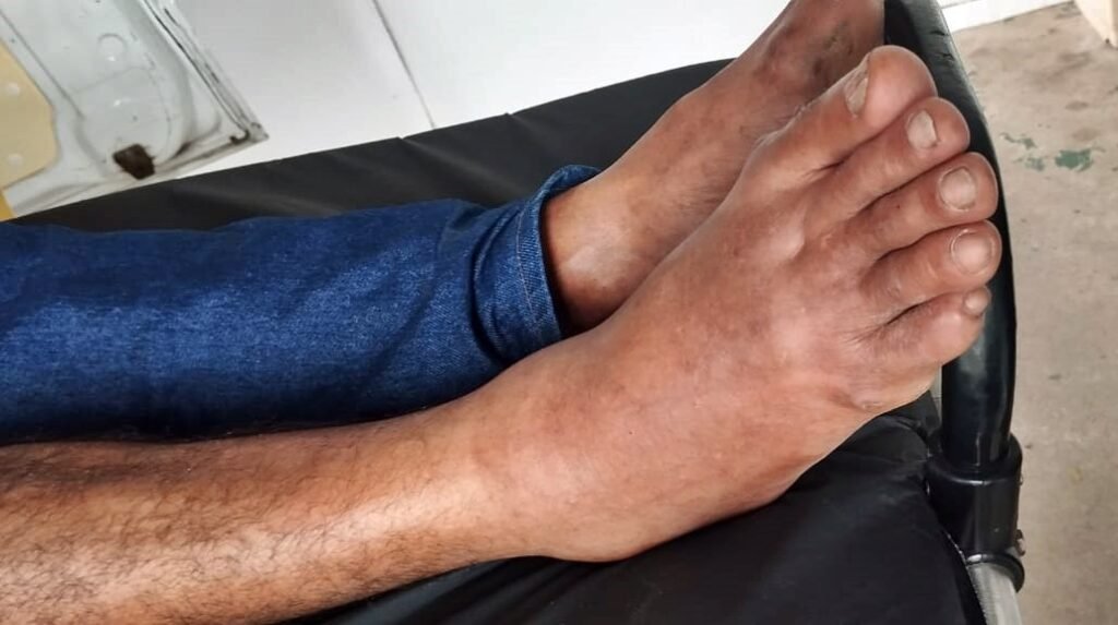 Homem é socorrido às pressas após ser picado por cobra em São Miguel dos Campos