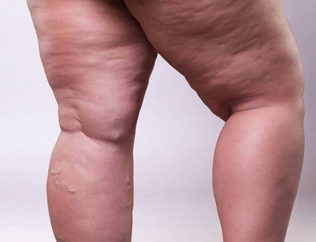 Lipedema atinge cerca de 12% das mulheres