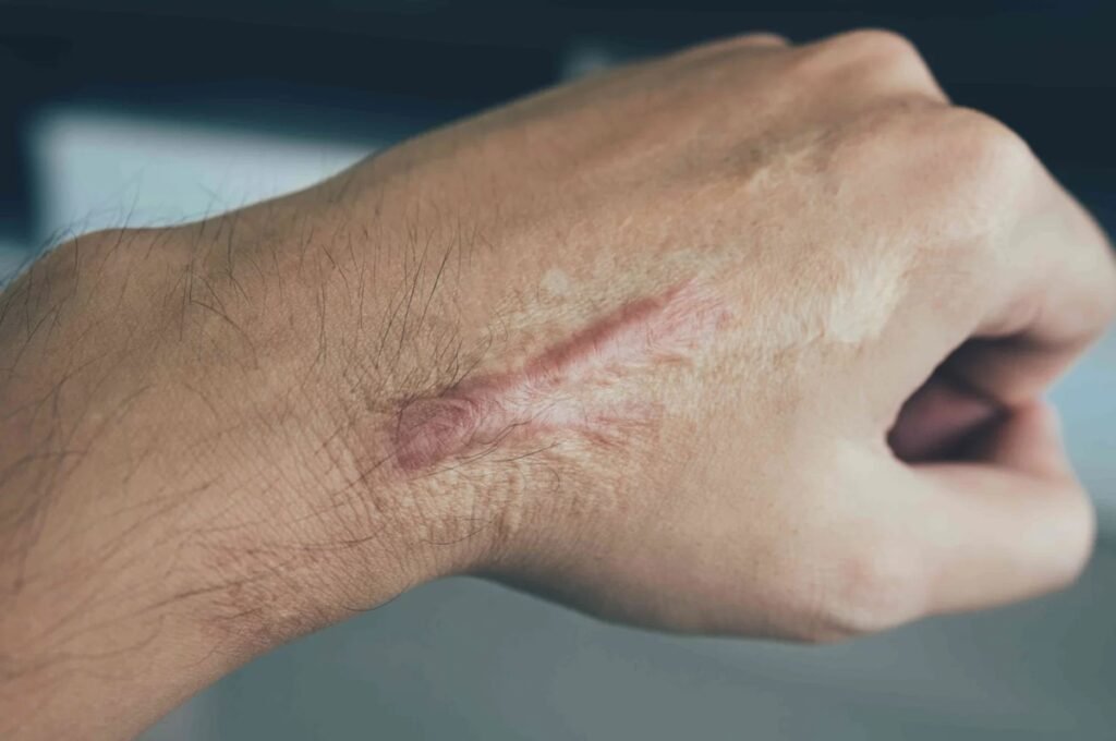 Queloide: o que é e como evitar?