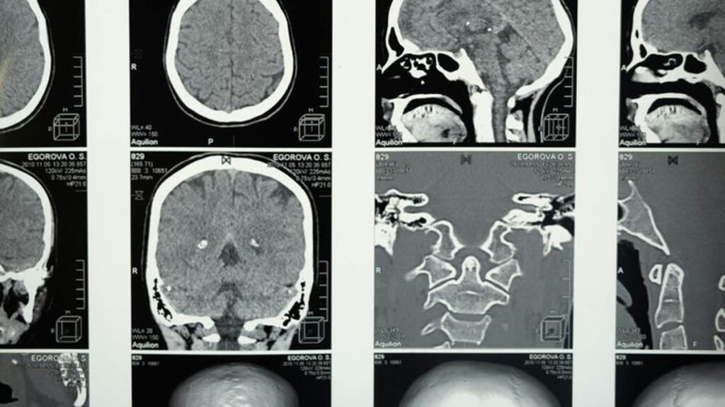Implante cerebral faz pessoa com paralisia voltar a falar 2 idiomas