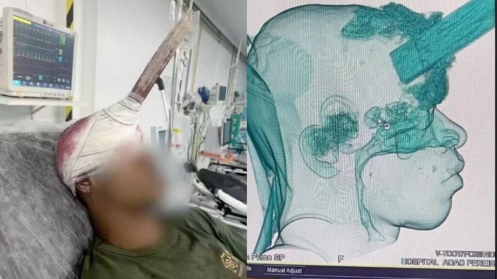 Carpinteiro relata desespero após estaca de 6 cm atingir seu crânio