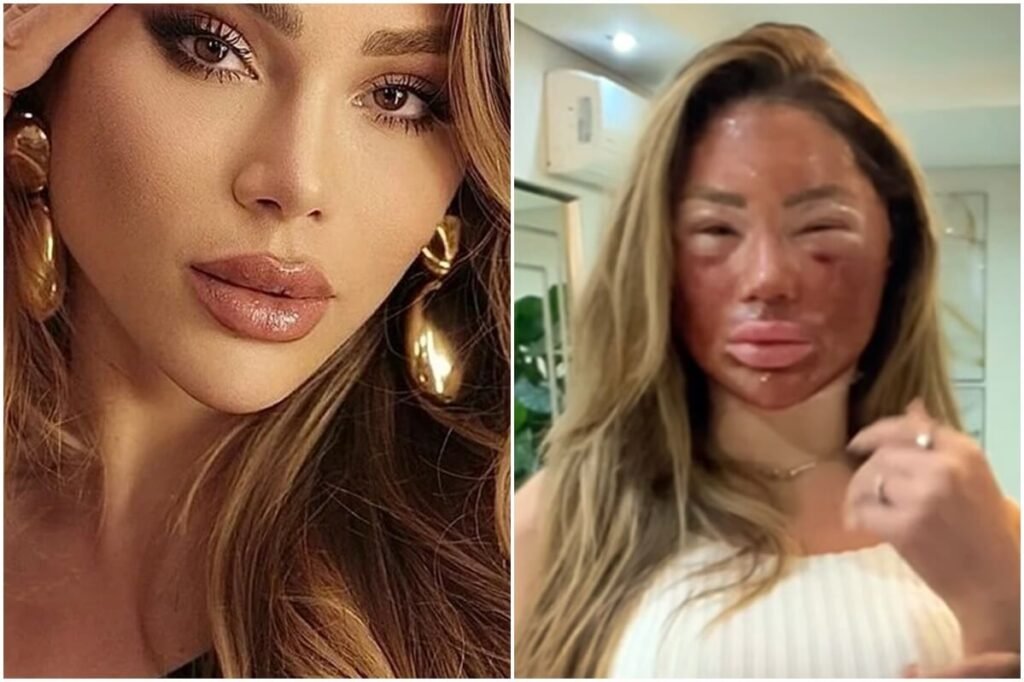 Incendiou o rosto, influenciadora exibe pós de peeling de fenol