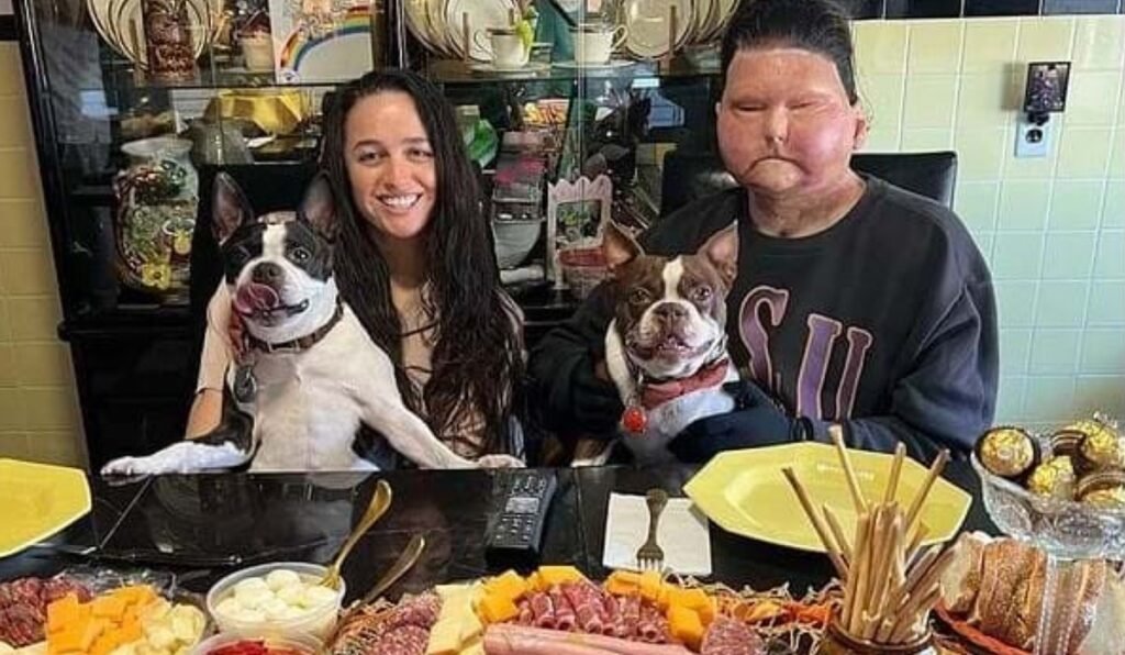 Jovem com transplante de rosto e mão encontra amor após acidente