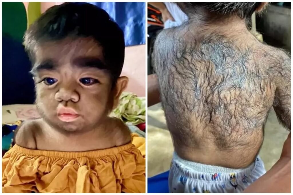 Nascimento de bebês com síndrome de lobisomem acende alerta vermelho sobre uso de minoxidil